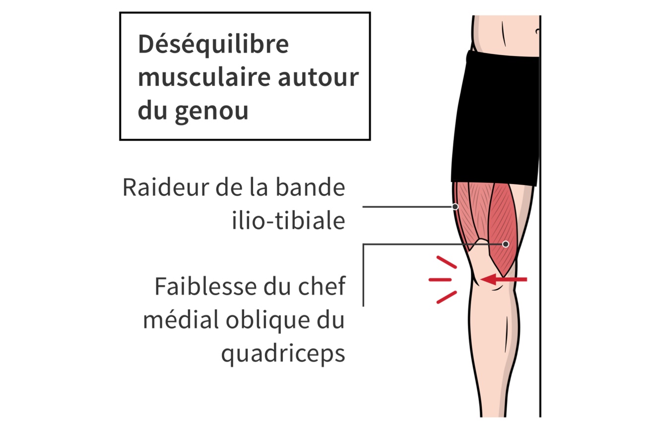 Un déséquilibre musculaire autour du genou