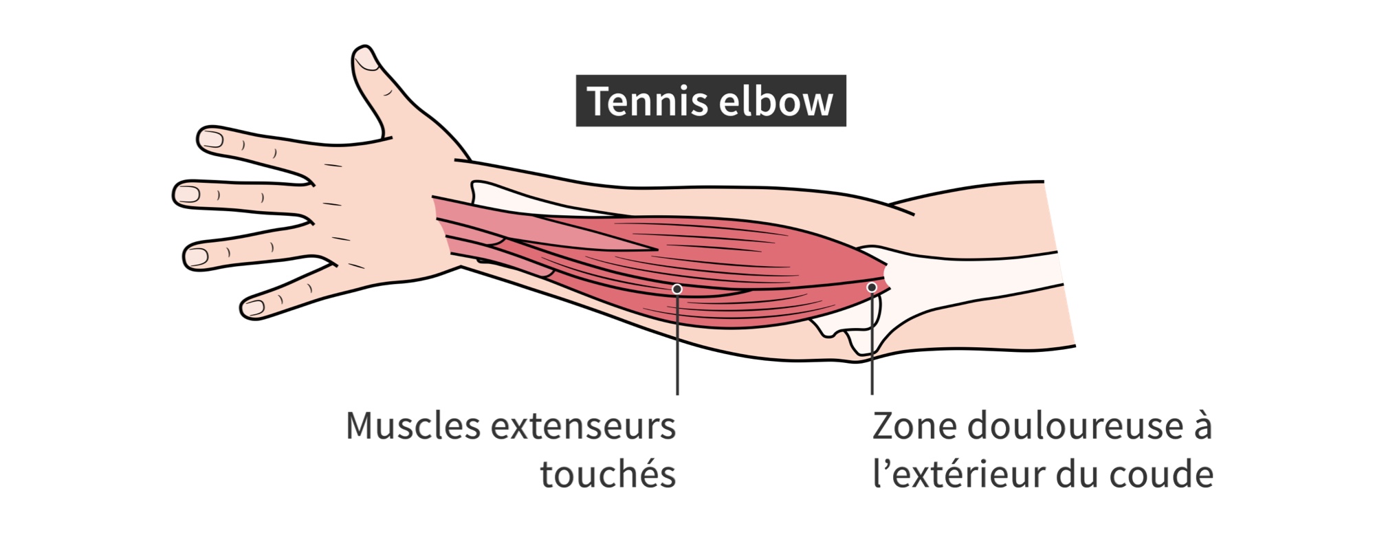 Muscles extenseurs des avant-bras