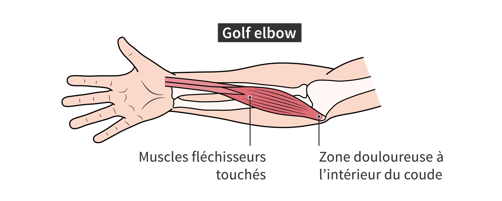 Muscles fléchisseurs des avant-bras