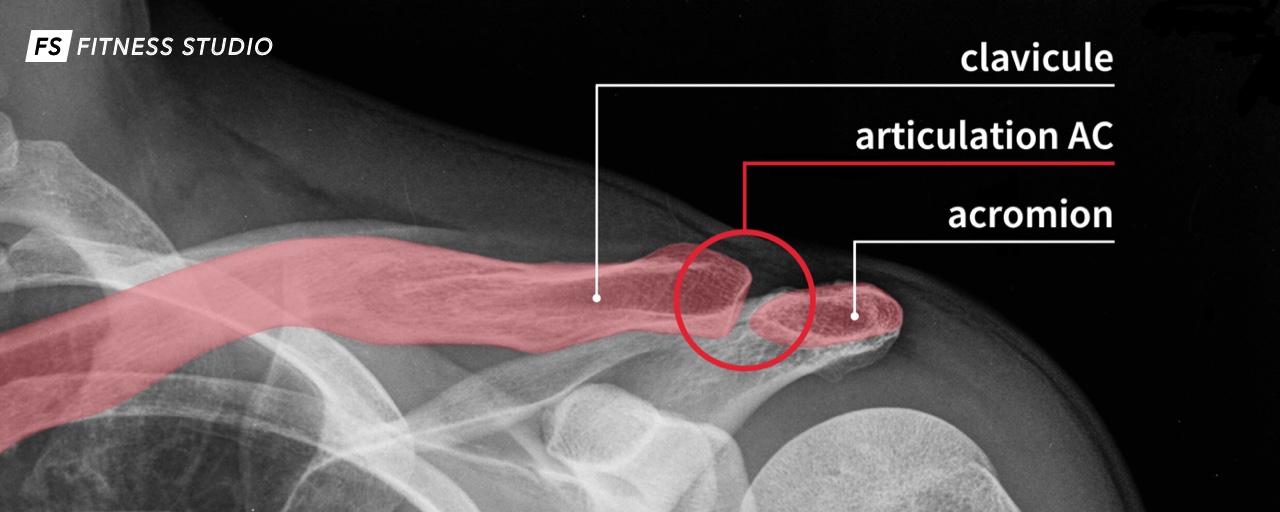 rehab conflit sous-acromial