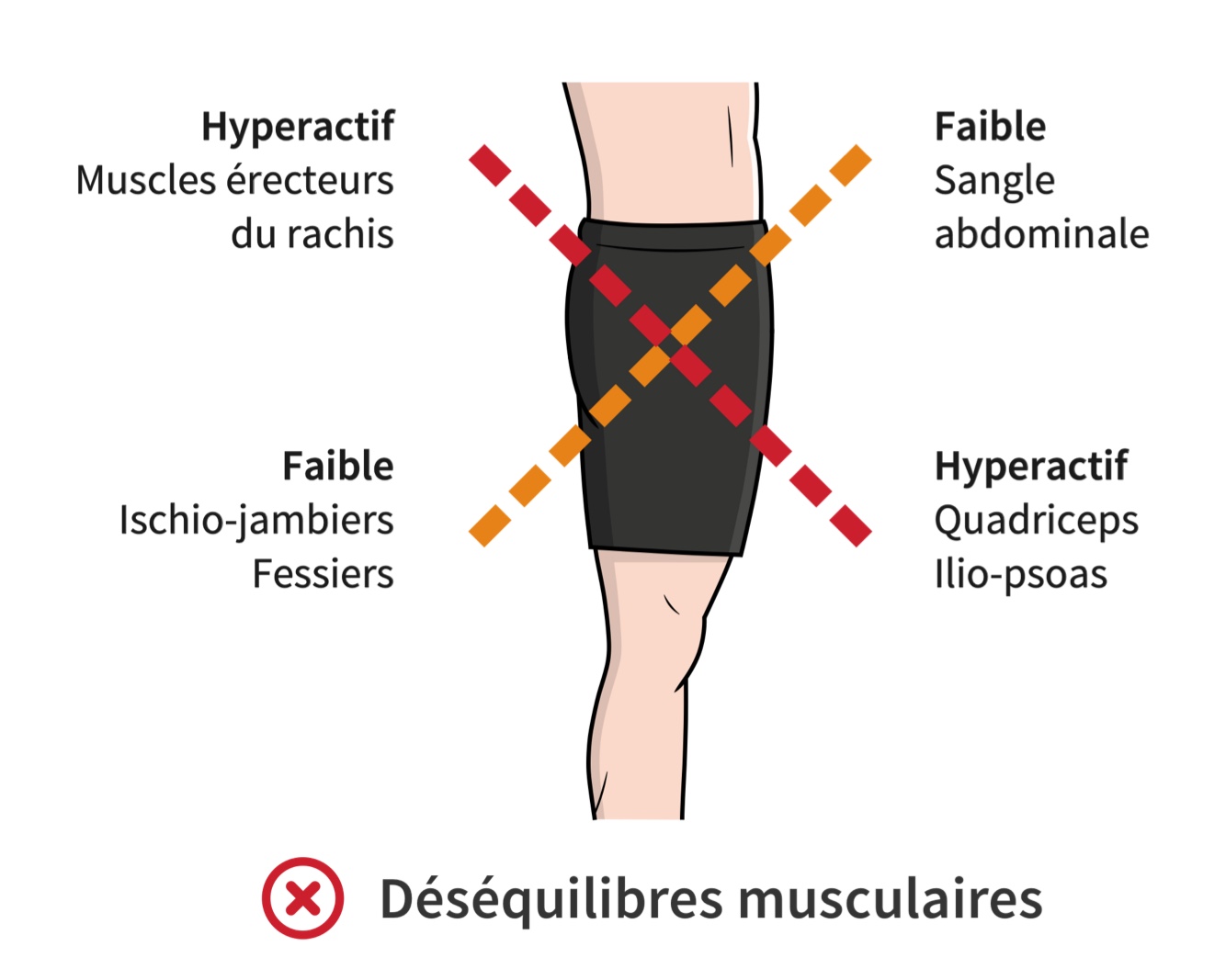 Déséquilibres musculaires au niveau des hanches