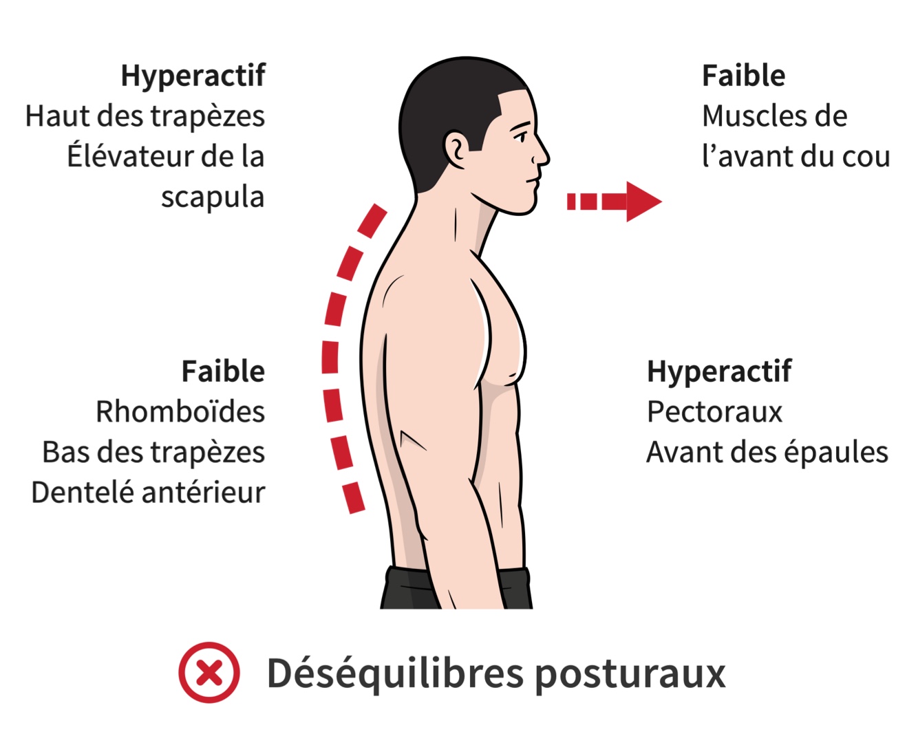 Déséquilibres musculaires et posturaux