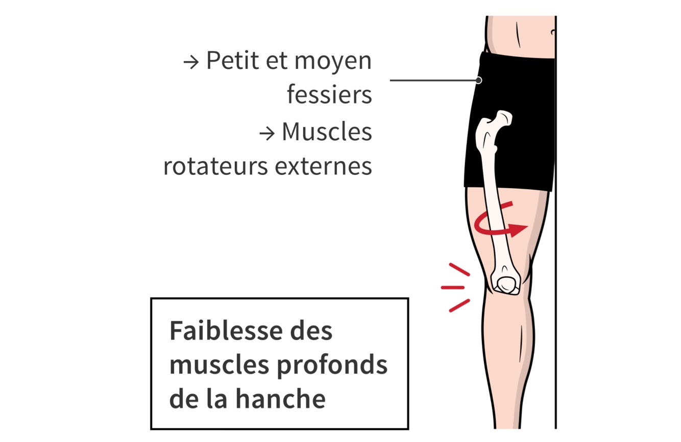 Une faiblesse des muscles profonds de la hanche